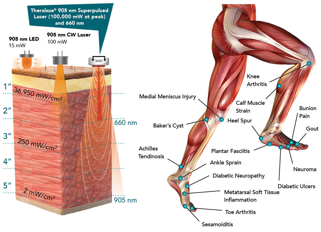 theralase Treatable podiatric conditions