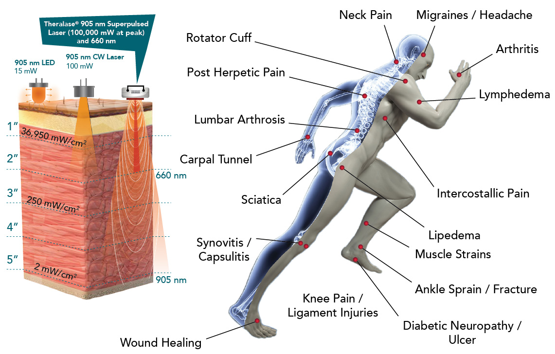 Theralase therapeutic lasers for chiropractors